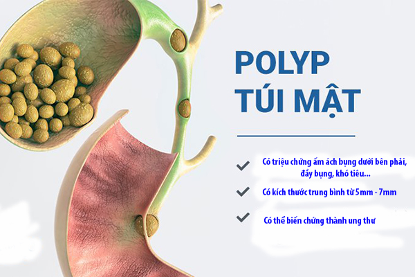 Polyp túi mật là một bệnh khá phổ biến, có thể xuất hiện ở mọi lứa tuổi nhưng chủ yếu gặp ở người trưởng thành.